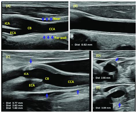 plaque scan carotid intima-media thickness testing or cimt|internal carotid thickness test.